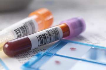 new blood test to quickly diagnose skin cancer 