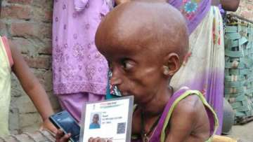 progeria case
