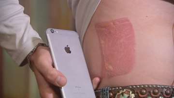 man was burned by his wet iPhone 