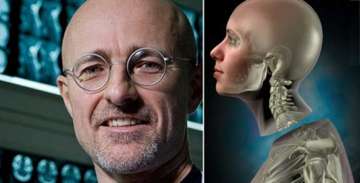 All you need to know about the first human head transplant