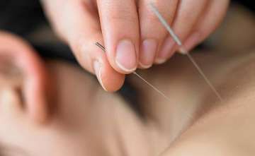 acupuncture for PCOS induced infertility