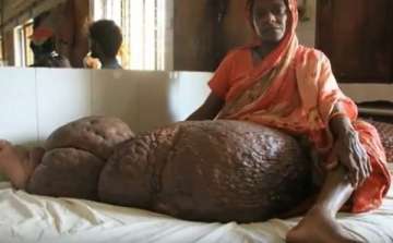 bizarre medical condition bangladesh woman