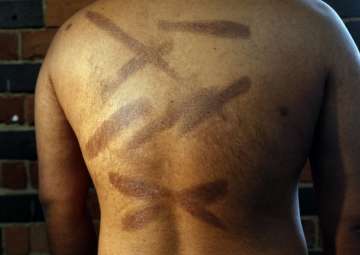 In this July 18, 2017, photo, a Sri Lankan man known as Witness 199 shows the scars on his back during an interview in London