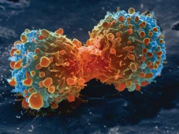 Colon cancer (A representational image)