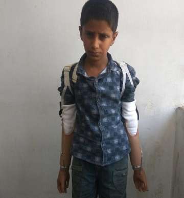 7-year-old Iqbal gets prosthetic hands by CRPF