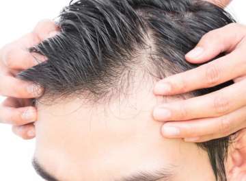 New cure to treat male baldness found