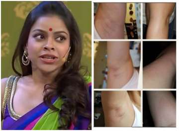 The Kapil Sharma Show’s Sumona Chakravarti suffers bruises and blotches; here’s what happened