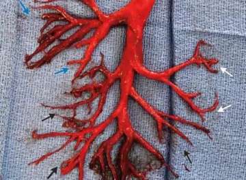Man coughs out 6-inch big blood clot formed in exact shape of a lung passage