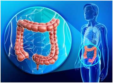 Colorectal cancer definition, signs and symptoms; Know how to reduce the risk of such cancer