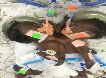 Narayana Health City performs surgery on conjoined twins with shared heart