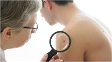 High Vitamin A intake can lower skin cancer risk