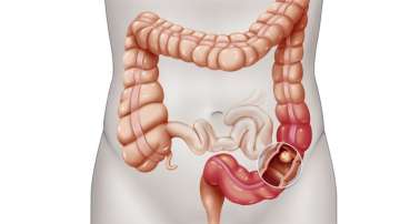High-fat diet may increase colon cancer risk