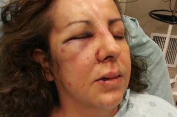 Mother beaten, left with broken nose by teenage girls after she intervenes in bullying