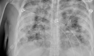 1st patient dies of mysterious pneumonia outbreak in China