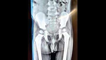 Telangana: 3-year-old complains of pain; X-ray reveals 11 needles inside back, private parts