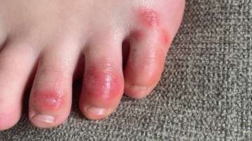 This April 3, 2020 photo provided by Northwestern University shows discoloration on a teenage patient's toes at the onset of the condition informally called "COVID toes." The red, sore and sometimes itchy swellings on toes look like chilblains, something doctors normally see on the feet and hands of people who’ve spent a long time outdoors in the cold