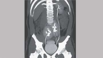 Man suffering from back problem finds out he has 3 kidneys