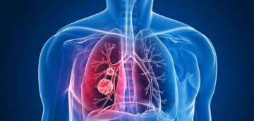 Lungs of dead COVID-19 patients show distinctive features: Study