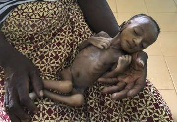 One-month old Haboue Solange Boue, awaiting medical care for severe malnutrition, is held by her mot