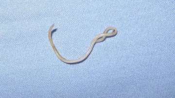 38-mm long Roundworm found in woman's tonsil in Japan