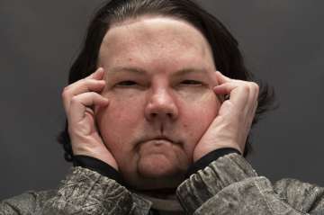 Joe DiMeo poses for a portrait at NYU Langone Health in New York, six months after an extremely rare