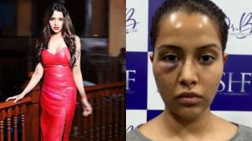 Tamil actress Raiza Wilson's face surgery goes wrong, shares photo blaming dermatologist 