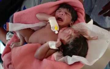 Odisha: Conjoined twins born in Kendrapara with two heads, three arms
