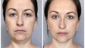 Bid goodbye to facial fat with these simple facial exercises