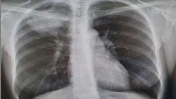 Lung cancer