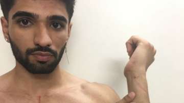 Bigg Boss OTT: Zeeshan Khan shares his injury photos