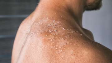 Tips to treat skin burns after using certain cosmetic products 