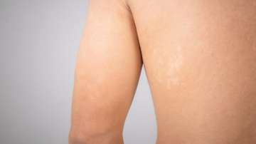 All about tinea versicolor-- causes, treatment and prevention