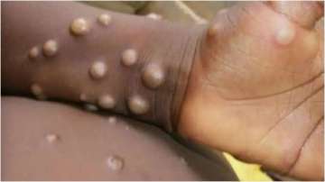 monkeypox, monkeypox virus, belgium, monkeypox, monkeypox cases, monkeypox in europe, monkeypox live