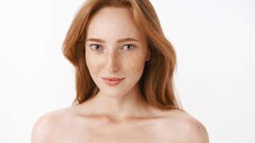 Is summer worsening your Melasma?