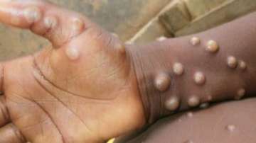 The man, in his thirties, is not a contact of the first reported case of monkeypox in the national capital.