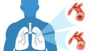 World Lung Cancer Day 2022