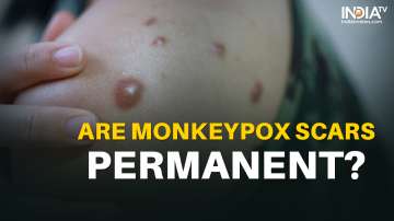 Are monkeypox scars permanent?