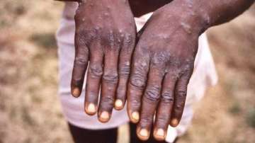 So far, 11 cases of monkeypox have been reported in India -- five from Kerala and six from Delhi.