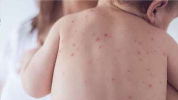 Cases of measles on rise in Mumbai