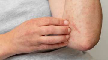 Representative image of a person having skin allergy