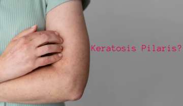 Keratosis Pilaris