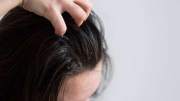 Dandruff: here are easy home remedies 