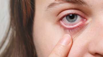 flesh eating bacteria ate man's eye during sleep