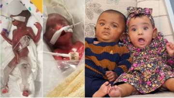 World's Most Premature Twins Celebrate 1st Birthday