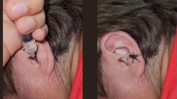 Live spider crawling out of man's ear