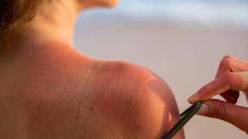 Ayurvedic Remedies for Heat Rashes and Sunburns