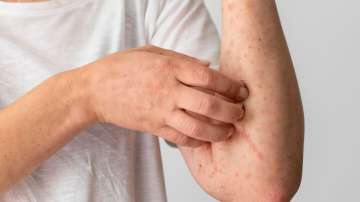 Eczema: Here are some home remedies 
