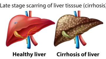 World Liver Day 2023: Stages of liver cirrhosis and its management