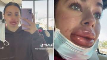 Influencer gets botched lip filler