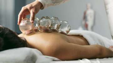 Cupping therapy